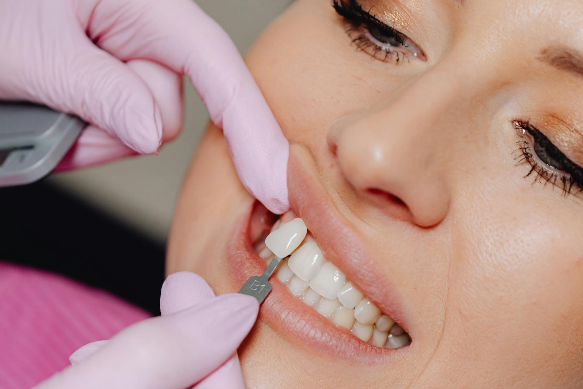 Faccette estetiche dentali